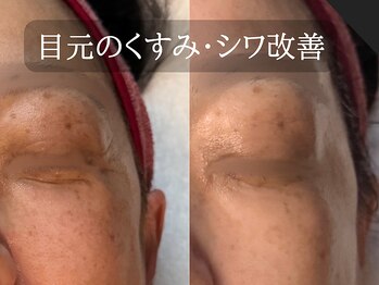 ミトラ(MITRA)/水光リフトfacial2回でシワ改善!