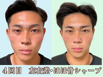 ナチュラルビューティーフェイス 横浜(NBF)/４回目MENS小顔矯正／横浜小顔