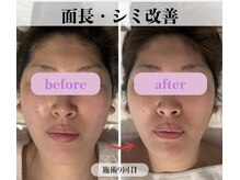ミピマム 横浜駅前店/面長・シミ改善BeforeAfter