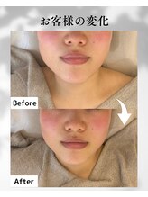 エムボーテ 太田店(M BEAUTE33)/顔筋小顔コルギ