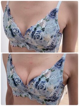 アンドモア(&more)/バストアップ症例