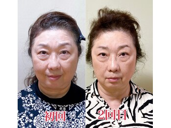 小顔22 ボルティ 赤坂支店(Bolty)/小顔シンメトリー矯正（1回）