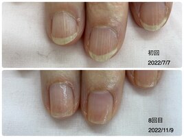 自爪育成