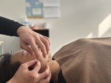 たてもと鍼灸接骨院の雰囲気（お顔への美容鍼灸の様子、美容鍼用に特に細い鍼を使用。）