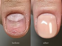 爪悩み専門店/深爪and凹凸爪の当日変化