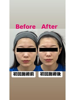 ゆうはり鍼灸整骨院 恵比寿/お客様Before　After