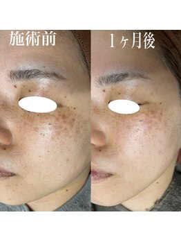 コリー(Kolly)/シミケア