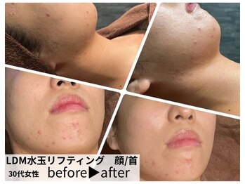 サロンスペース/韓国LDM水玉リフティング 顔+首