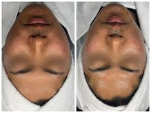 ヴェーラベレッツァ(Vera Bellezza)/リフトアップ（1回目）