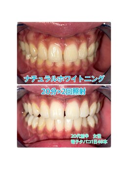 プラチナムビューティー 川口駅前店(PLATINUM BEAUTY)/煙草のヤニもしっかり分解