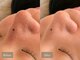 コア ビューティースタジオ(KOA Beauty Studio)の写真/【艶肌ワックス×毛穴洗浄】イチゴ鼻・小鼻の角栓もスッキリ◎産毛も除去して明るくなめらかな艶肌へ♪