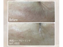 ルミナ(Lumina)の雰囲気（剥離なしでエイジングケアにもしっかりアプローチ◎）
