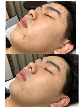 ナチュライズ(NatuRise)/ニキビケア、赤み、毛穴