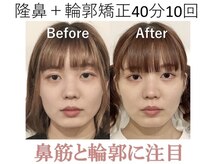ラプリ 大阪心斎橋店(Raplit)/隆鼻＋輪郭矯正40分10回