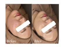 ベルティーク(BELTHEQUE)/肌管理/ララピール/ピーリング