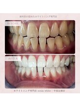 エクシアホワイトニング 札幌中島公園店/Before After［ホワイトニング］