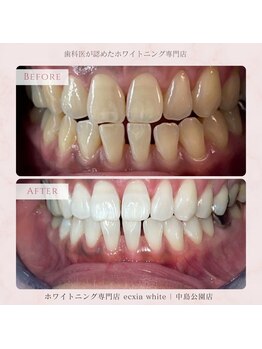 エクシアホワイトニング 札幌中島公園店/Before After［ホワイトニング］