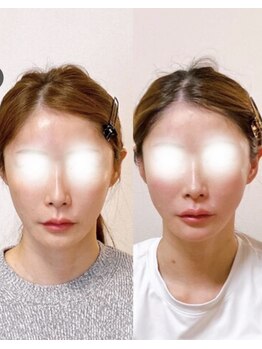 小顔22 ボルティ 本店(Bolty)/超レア【中顔面を縮めたい！】