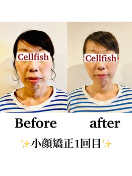 セルフィッシュ(Cellfish)/小顔矯正