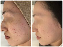 カラン(CALIN)/グリーンハーブピーリング