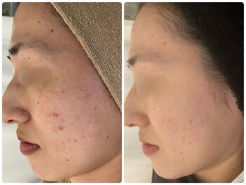 カラン(CALIN)/グリーンハーブピーリング