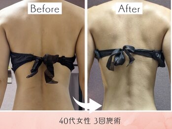 ラグーン(Lagoon)/WINBACK×筋膜リリース