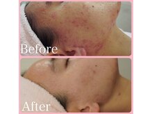 クイーン 熱海店(Queen)/3カ月後のキレイなお肌を目指す