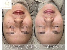 サロンドレナ 名駅店/ハーブピーリング サロンドレナ