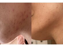 れふぇるん 足利店/40代 ニキビケア 施術12回