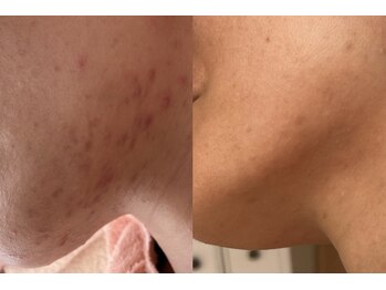 れふぇるん 足利店/40代 ニキビケア 施術12回