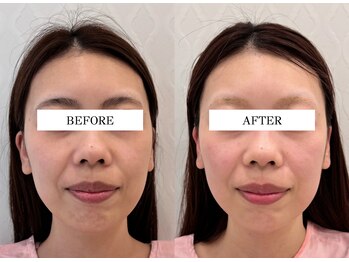 ハリランス(HARILANCE)/小顔/ほうれい線/若見え