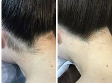 脱毛サロン ベル(Bell)/【レディース脱毛】