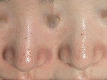 ウィハナ(wehana)/【毛穴洗浄×ララピール】