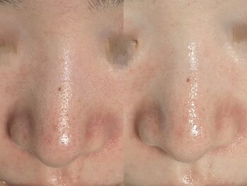 ウィハナ(wehana)/【毛穴洗浄×ララピール】