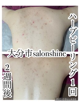 サロンシャイン(Salon Shine)/背中ハード