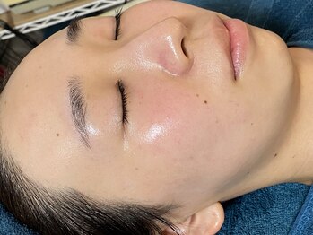 リノルーア(Linolua)/ハーブピーリング