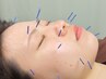 2回目以降の方【美容鍼コース】施術内容/平日/土日祝日で料金が異なります!