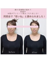 ビーホリック(Bholic)/フェイスラインもたつき、クスミ