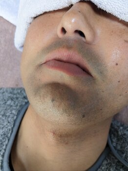 サイ(sai)/髭脱毛