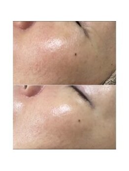 プレイス 天王寺店(PLACE)/ハーブピーリングのお客様です！