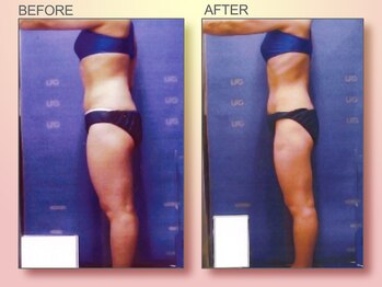 ジュリア オージェ 天王寺店/ ビフォーアフター（脂肪燃焼）