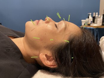 アディクト(Addict)の写真/お悩みの根本原因へツボ刺激!美容鍼専門店なので、今まで解決しなかった肌悩みやフェイスラインに変化実感!