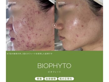ビゼン(BIZEN)の写真/【繰り返すニキビ、何をしても良くならないニキビにお悩みの方】是非一度お越しください！