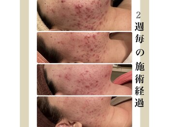 シンデレラ しみケア(Cinderella)/ニキビケア