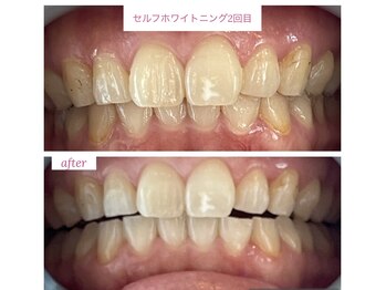 エスデザイン(es design)/セルフホワイトニング/鹿児島