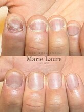 マリーロール 淀屋橋本店(Marie Laure)/深爪矯正/自爪風/自爪育成