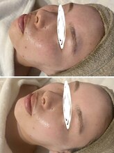 ホワイトアクア 中目黒店(WHITE AQUA)/ララピール1回！！