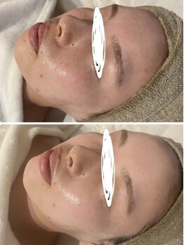 ホワイトアクア 中目黒店(WHITE AQUA)/ララピール1回!!