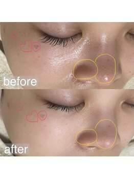 アルム(a'lm)/感動の毛穴レス体験★ 毛穴/小顔