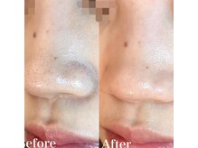 チュチュ(TUTU)/毛穴洗浄×ハーブトリートメント